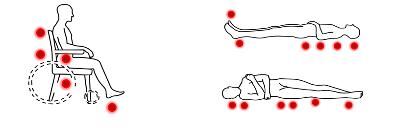 Zone corpo soggette a lesioni da pressione